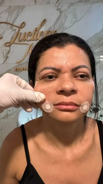 Cliente na clínica durante a aplicação de enzimas nas bochechas
